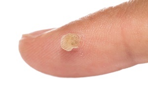 Karpų - odos liga, su kuriomis veiksmingai kovoja Skincell Pro