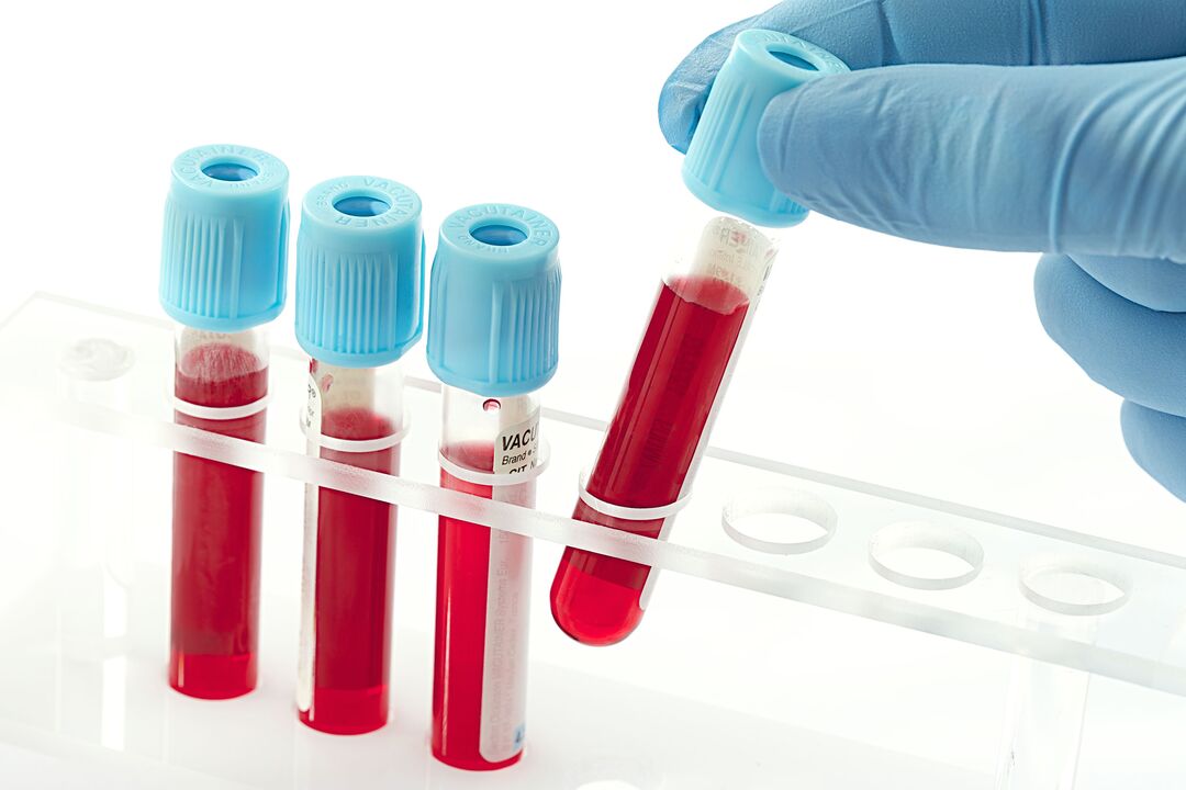 kraujo tyrimas žmogaus papilomos virusui diagnozuoti